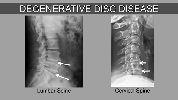 degenerative disc in thoracic spine
