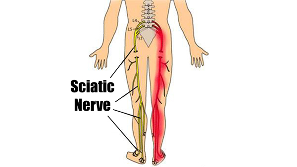 Sciatica Symptoms Including Back Pain and Leg Cramps